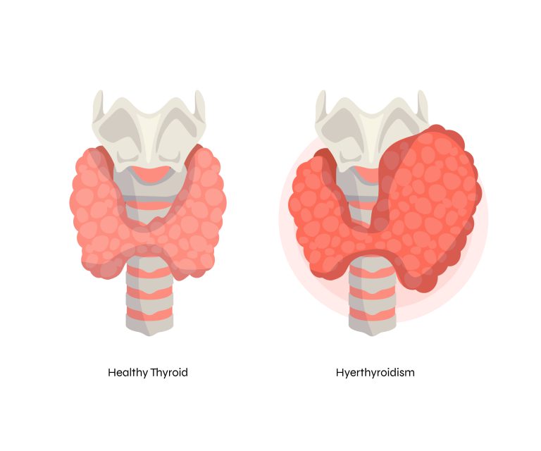 From Hypothyroid to Healthy From Hypothyroid to Healthy