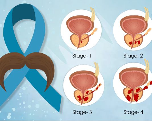 Prostate Cancer Stages
