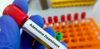 ADENOSINE DEAMINASE TEST