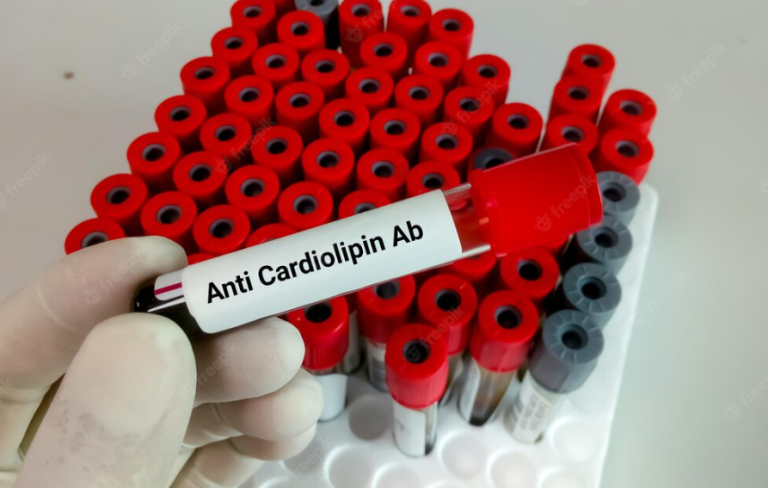 ANTI CARDIOLIPIN ANTIBODY (ACA) – IgM ANTI CARDIOLIPIN ANTIBODY (ACA) – IgM