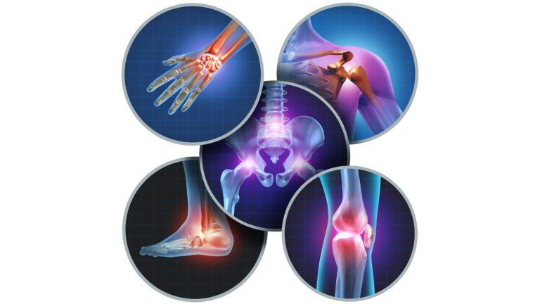 Outsmart the Arthritis- Keep moving! Outsmart the Arthritis- Keep moving!