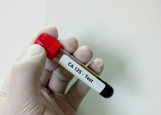 Cancer Antigen 125 test