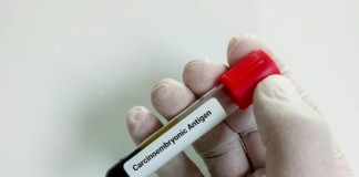 Carcinoembryonic antigen Test