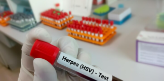 Herpes Simplex Virus