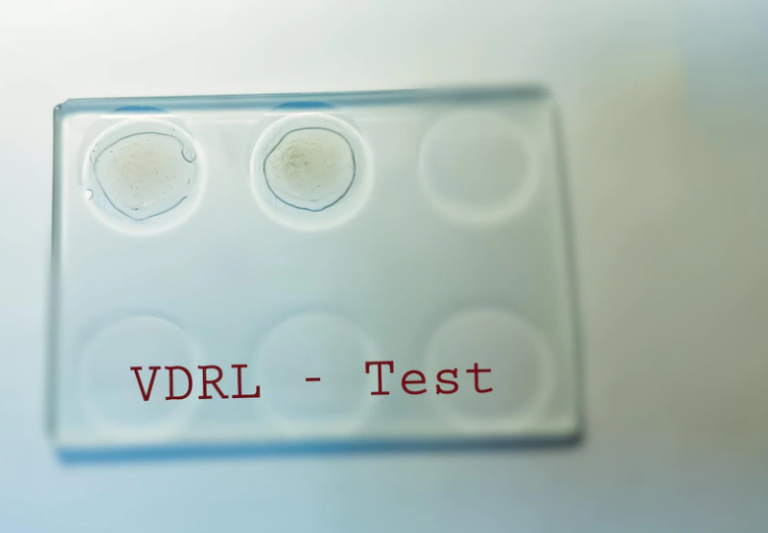 VDRL Test