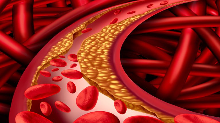 5 Things to Avoid Bad Cholesterol 5 Things to Avoid Bad Cholesterol